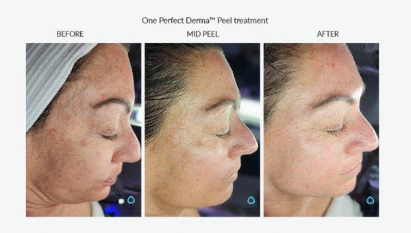 With Perfect Derma you will have beautiful skin in just 7 days.