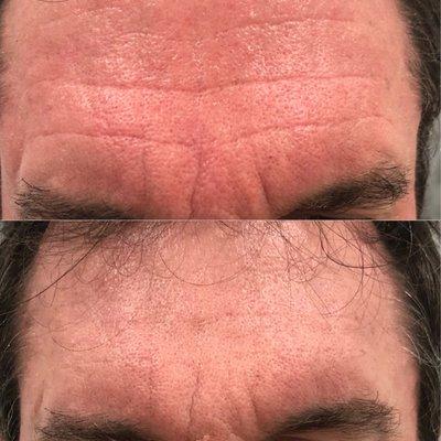 Forehead creases were treated with filler and Botox.