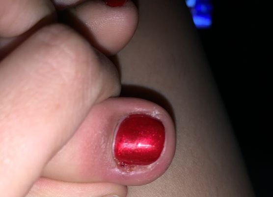 My infected nail.