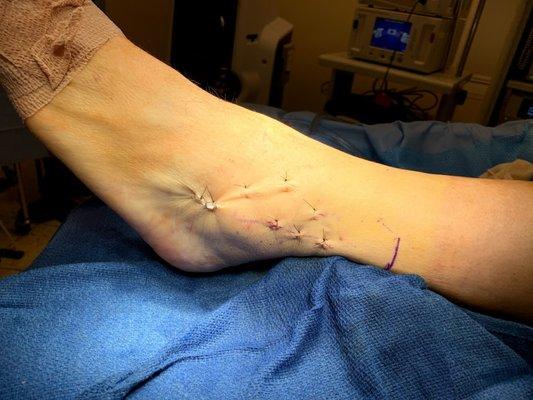 ankle fracture surgery: minimally invasive technique with smaller incisions, faster recovery to return to walking, exercise