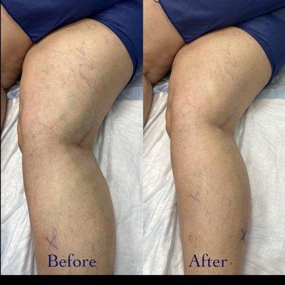 Before and After Foam Sclerotherapy