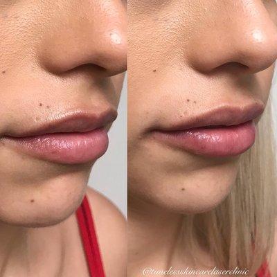 Lip Augmentation Before + After