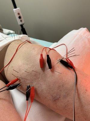 E-stim for knee pain treatment