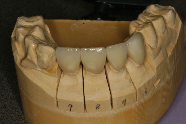 Crowns for a patient's front teeth! We have been working with our lab for over 10 years!