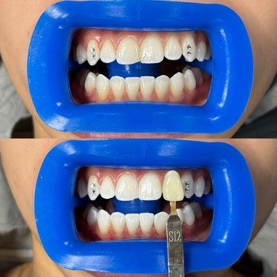 Before and after teeth whitening results.