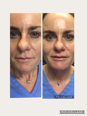 Chin Augmentation/Nasal Labial Folds with Bellafill