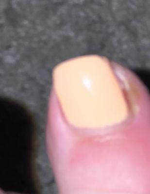 Toe irritated/infected