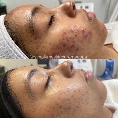 Simply Me Skin Care three month acne program by Face Reality: before and after, with a 100% success rate!