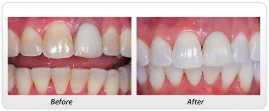 Malcomson Dentistry offers a teeth whitening program to patients.