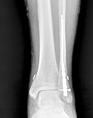 ankle fracture surgery: minimally invasive technique with smaller incisions, faster recovery to return to walking, exercise