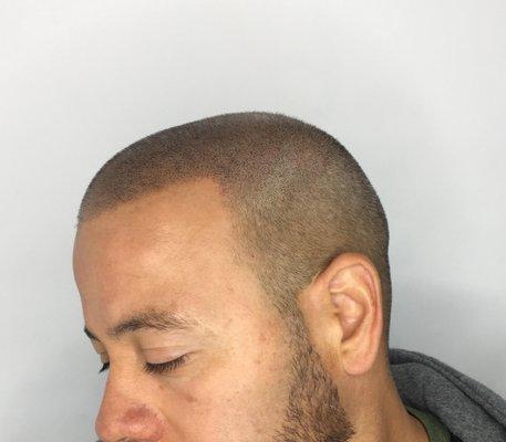 Hairline completely restored by ScalpClub Realistic Scalp Micropigmentation! He looks younger and his confidence is back!