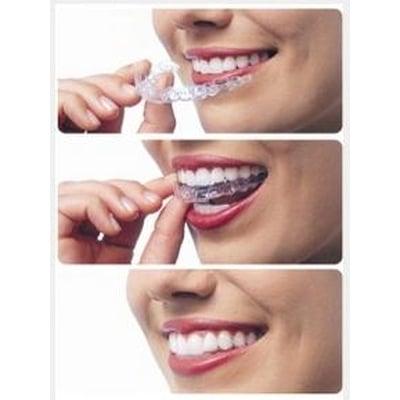 Teeth Whitening