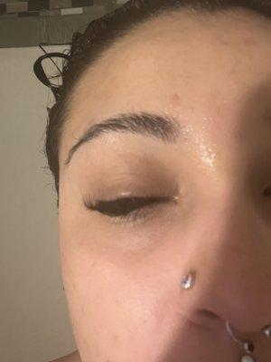 Swelling from overlapping lashes