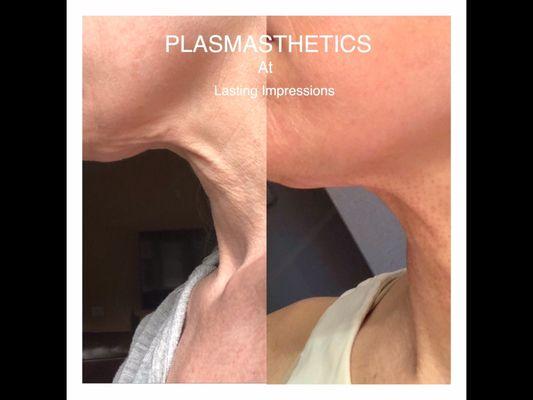 Crepey neck skin gone with one treatment.  Plasma Skin Tightening, at Lasting Impressions in Silverdale,