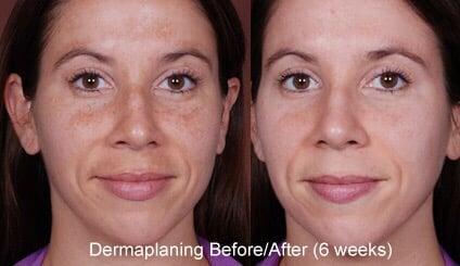 Before and after dermaplaning!