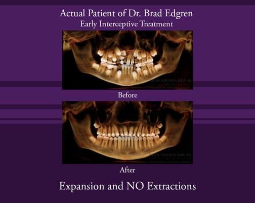 Before & After...Expansion and NO Extractions.