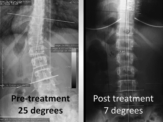 Non Surgical Scoliosis Treatment