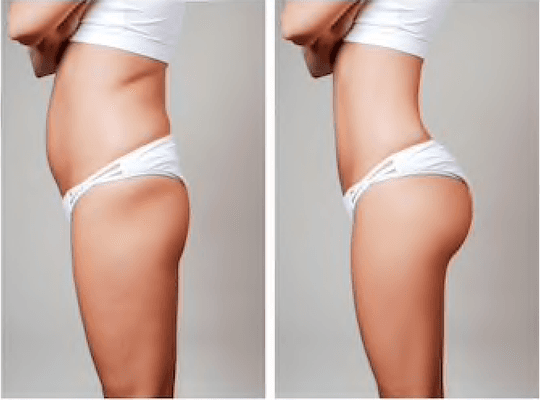 Libbe Colonic 60 min before & after