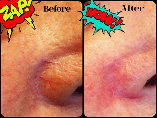 Before & After of Spider Vein & Pore treatment . A bit red in the After photo but that will calm down. Great turn out on a wonderful client.