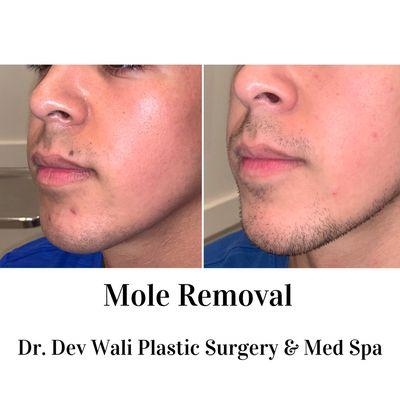 Mole Removal