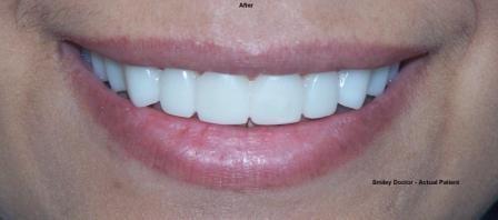 Smiley Doctor Patient After Treatment with Snap on Smile