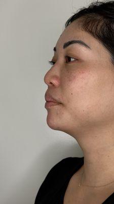 After - chin filler