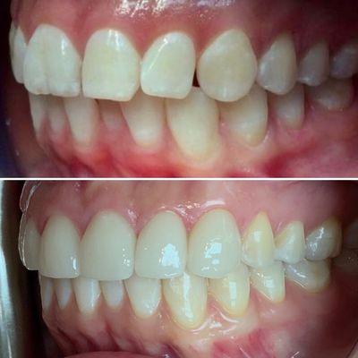 Cosmetic veneers used to enhance smile.