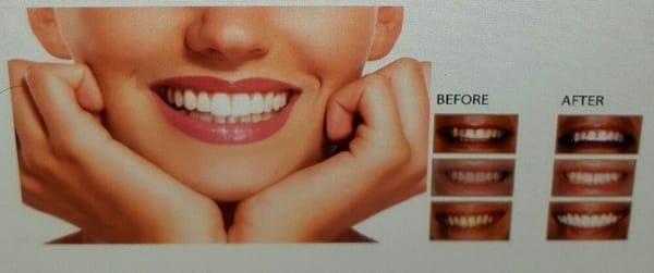 Produces fast results--safest form of tooth whitening --organic option available