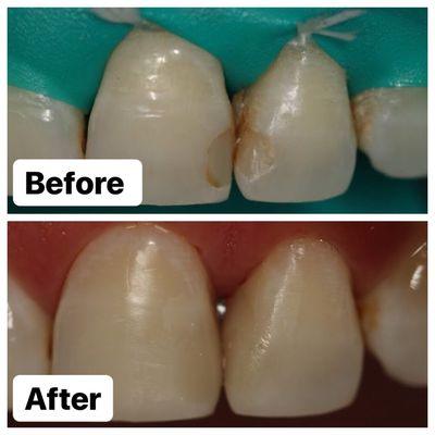 Replacement of old, leaking fillings