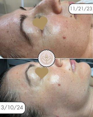 Anti-aging collagen stimulating PCA chemical peel. Facial treatment brightening minimize wrinkles  lines.