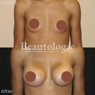 Bilateral Breast Augmentation with 350ml Saline Implants Before and After