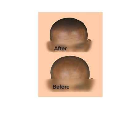 Baldness smp treatment