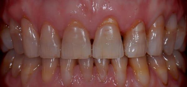 Patient has tetracycline-stained teeth, would like brighter teeth, and to close spaces between teeth.