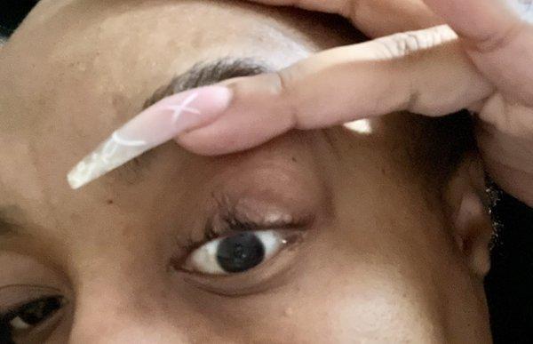 5 days after left eye