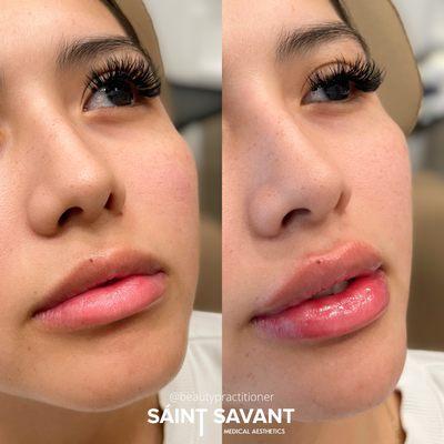 LIP & CHIN Enhancement using dermal fillers