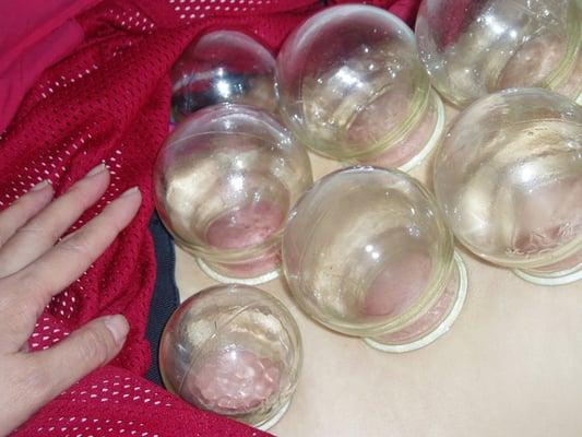 Fire Cupping