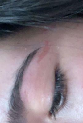 One side of her eyebrow where the skin was ripped off.