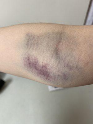 Bruise after drawing blood