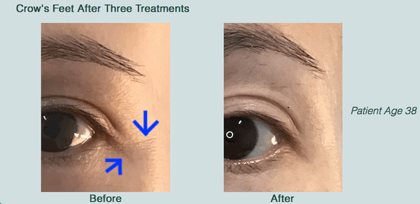 Crow's Feet after Cosmetic Acupuncture