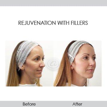 Rejuvenation with fillers