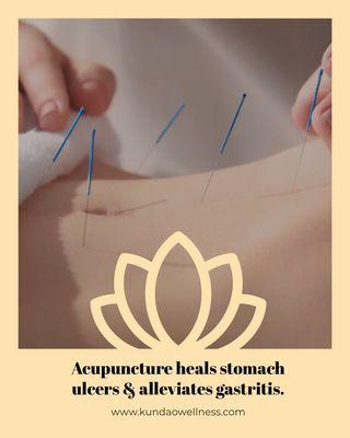 Acupuncture