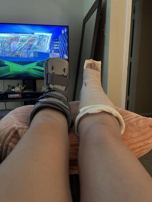 My sprained ankle got the boot my broke ankle has the splint!!