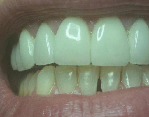 After whitening.  Amazing results !!!! Excellent price!!!