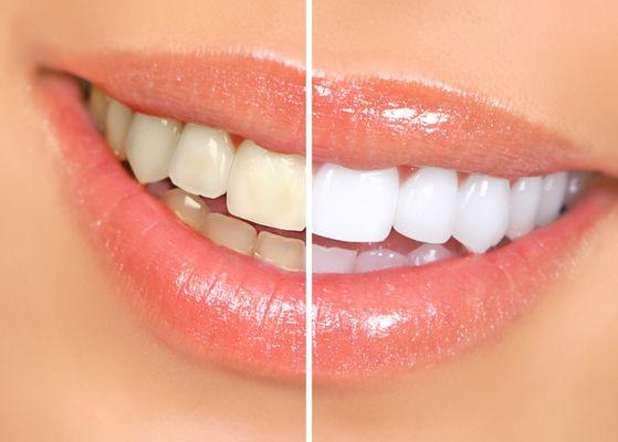 Teeth whitening services available here! Call us today for more information. 718.432.0300!