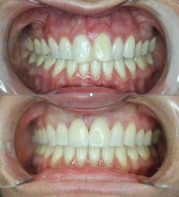 Another beautiful result by Dr. Lentz with clear correct braces and porcelain veneers.  Call Lanier Valley Dentistry for consulataion.