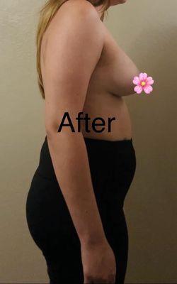 After breast augmentation