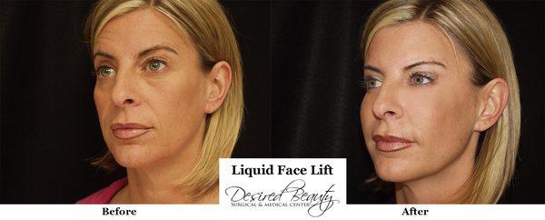 One of our customers looking rejuvenated after her Liquid face lift. #DrKerendian #LiquidFaceLift