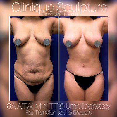 (9 Months Post-Op) 
 8A Around the World Liposculpture with a Mini Tummy Tuck and Fat Transfer to the Breasts.