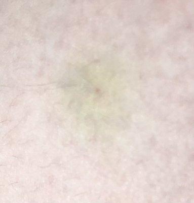 Bruise beginning on my leg