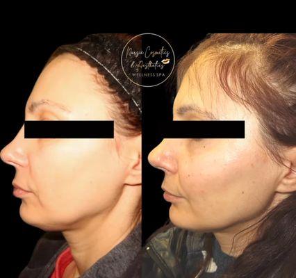 Midface & Facial Balancing